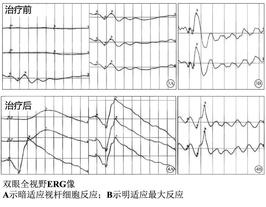 维生素A油，守护视力的天然卫士