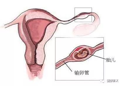 宫外孕后还能怀孕吗？——科学解读与心理调适