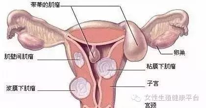 卵巢巧克力囊肿对女性生育能力的影响及应对策略