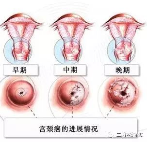 阴道镜检查，女性健康的重要守护者